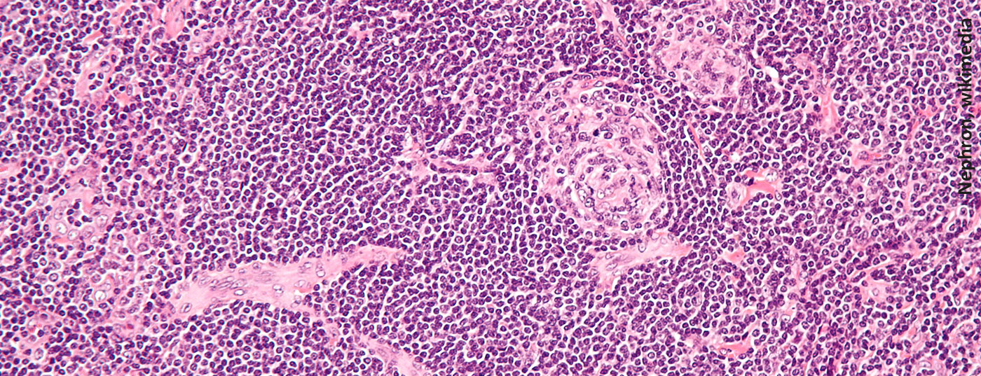 castleman_disease_-_high_mag