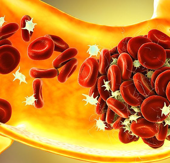 thromboembolie_istock-1349351825