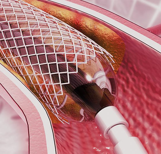 stent_istock-1183309129