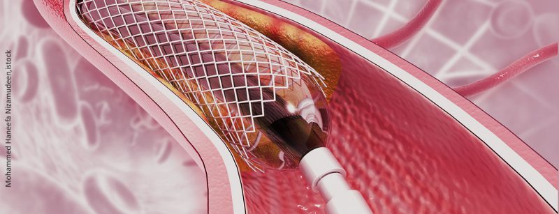 stent_istock-1183309129