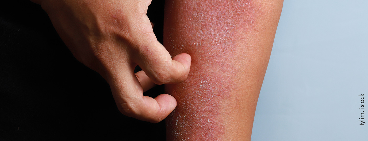 atopderma_istock-1270950737