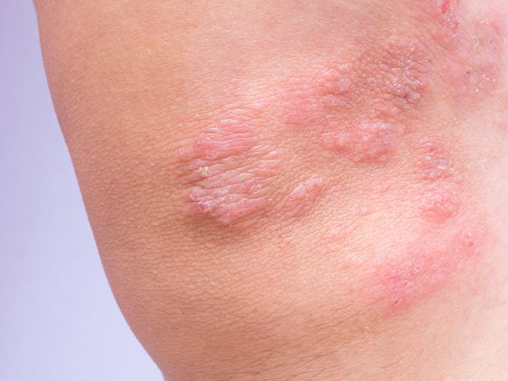 atopische_derma_istock-1170007607