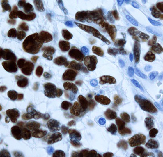 glioblastoma_p53