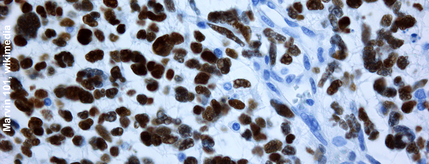 glioblastoma_p53