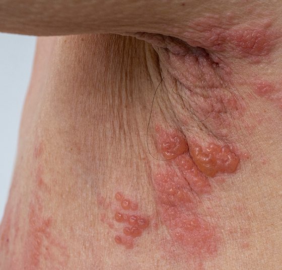 guertelrose_herpeszoster_istock-1336259341